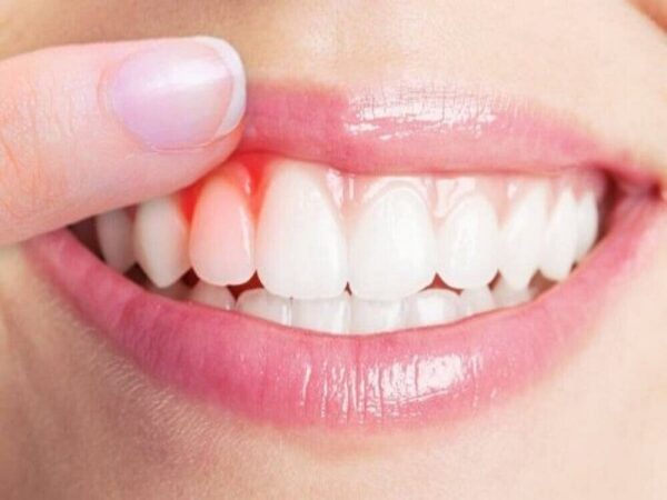 Hạn chế chảy máu chân răng